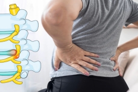 Bel Fıtığı Ameliyatı Sonrası Nüks: Neden Olur, Nelere Dikkat Edilmeli?