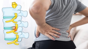 Bel Fıtığı Ameliyatı Sonrası Nüks: Neden Olur, Nelere Dikkat Edilmeli?