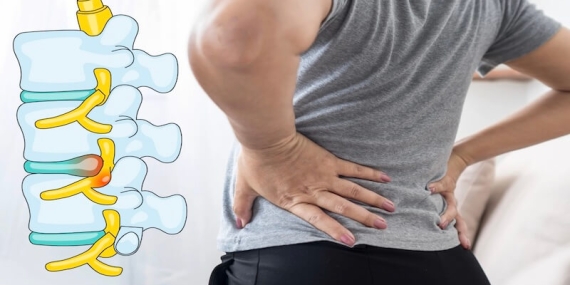 Bel Fıtığı Ameliyatı Sonrası Nüks: Neden Olur, Nelere Dikkat Edilmeli?