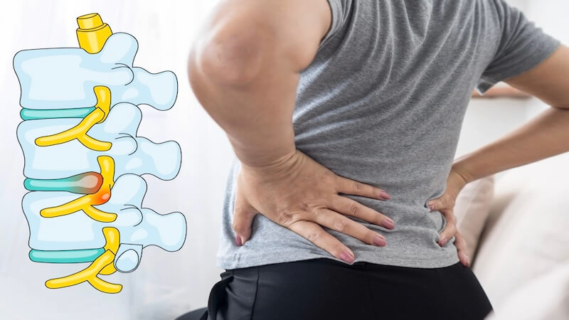 Bel Fıtığı Ameliyatı Sonrası Nüks: Neden Olur, Nelere Dikkat Edilmeli?