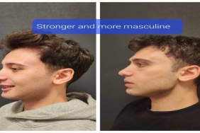 Çene İmplantı Öncesi Sonrası Dikkat Edilmesi Gerekenler