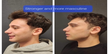 Çene İmplantı Öncesi Sonrası Dikkat Edilmesi Gerekenler