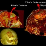Beyin Ameliyatlarında Dijital İkiz Dönemi