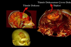 Beyin Ameliyatlarında Dijital İkiz Dönemi