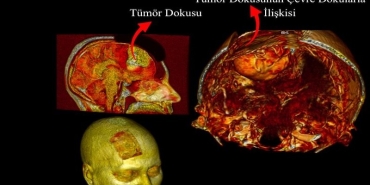 Beyin Ameliyatlarında Dijital İkiz Dönemi
