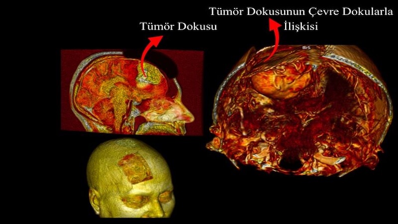 Beyin Ameliyatlarında Dijital İkiz Dönemi